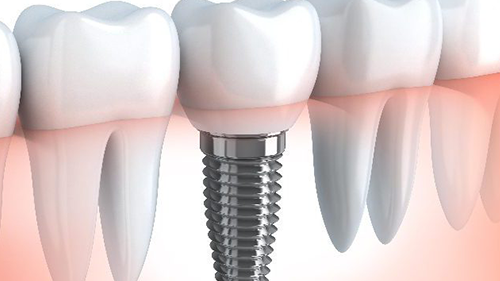 Implant dentar pret